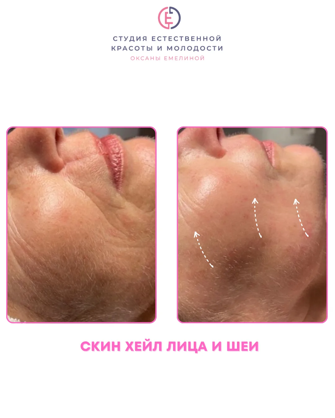 Почему все больше женщин выбирают Скин Хейл❓

1️⃣Нет боли и страха - идеально для тех, кто боится иг