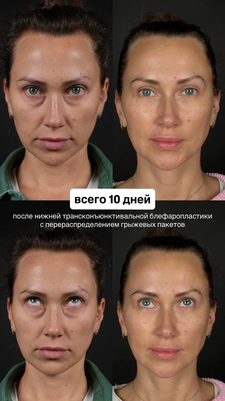 Естественный результат нижней блефаропластики💚