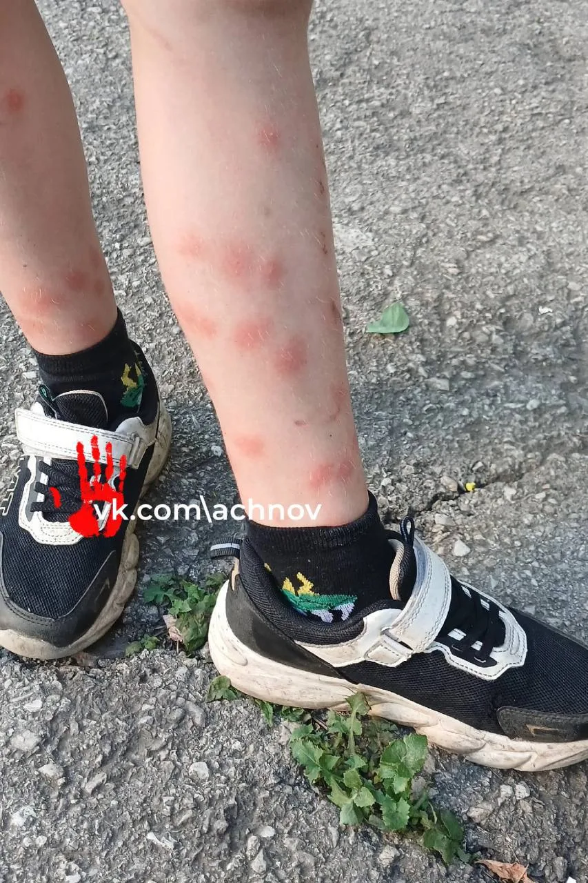 После отдыха на популярном пляже семья из Магнитогорска покрылась сыпью

По словам отдыхающих, после
