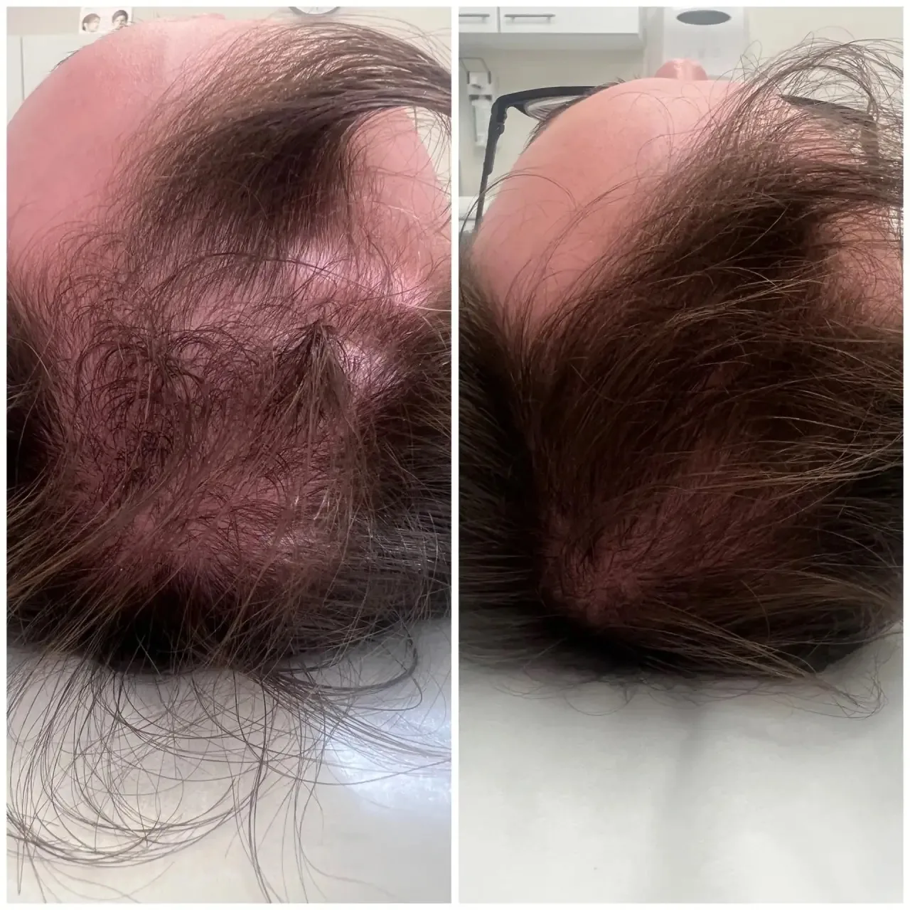 Великолепный результат после курса (4 процедуры) инъекций препарата Hair-Х у врача-косм...