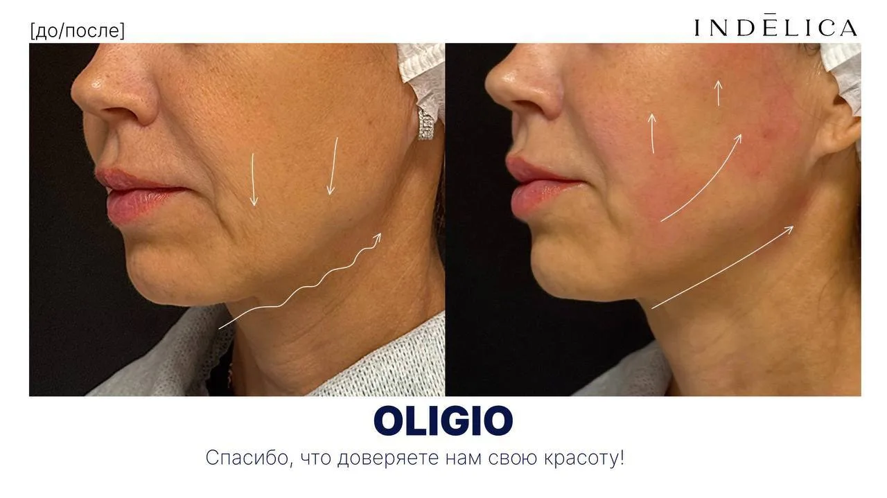 Овал теряет чёткость, кожа становится рыхлой, а упругость уже не та? 🙈