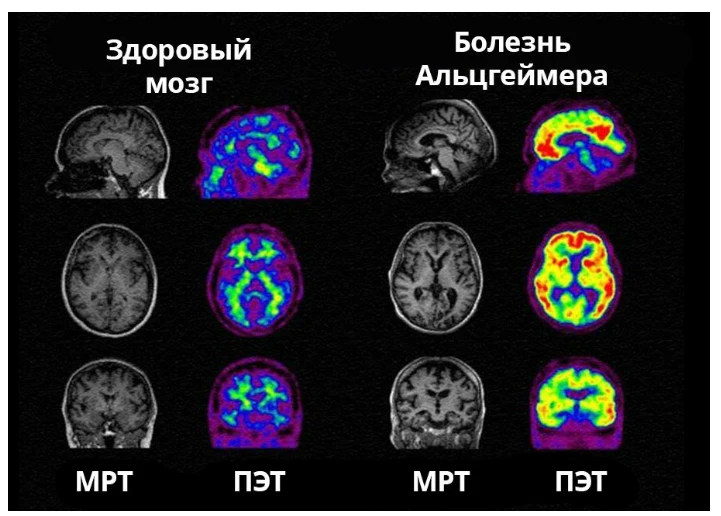🧠 АНАЛИЗ КРОВИ ВЫЯВИТ БОЛЕЗНЬ АЛЬЦГЕЙМЕРА ДО ПЕРВЫХ СИМПТОМОВ