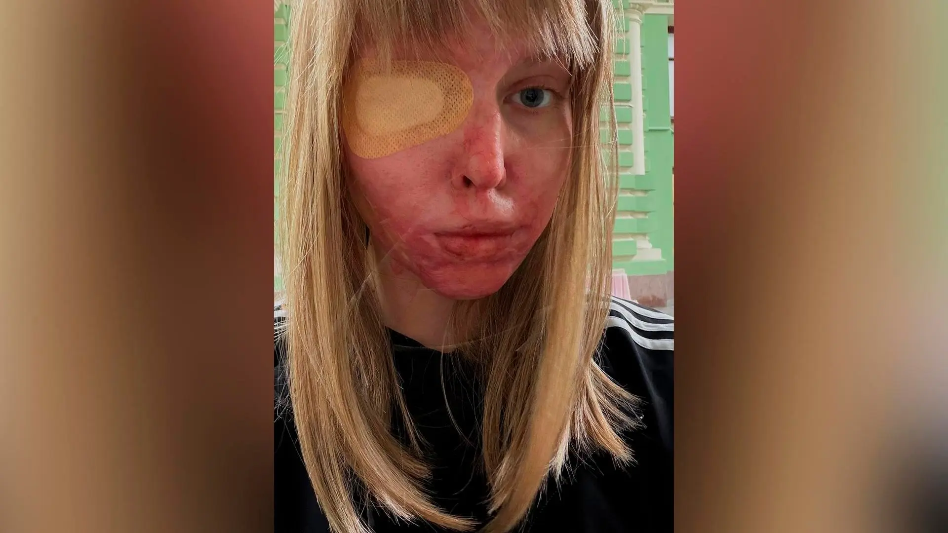 Облитая кислотой Анастасия Прокофьева продолжает восстанавливаться после нападения бывшего