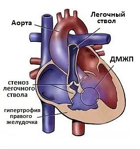 Врожденные пороки сердца