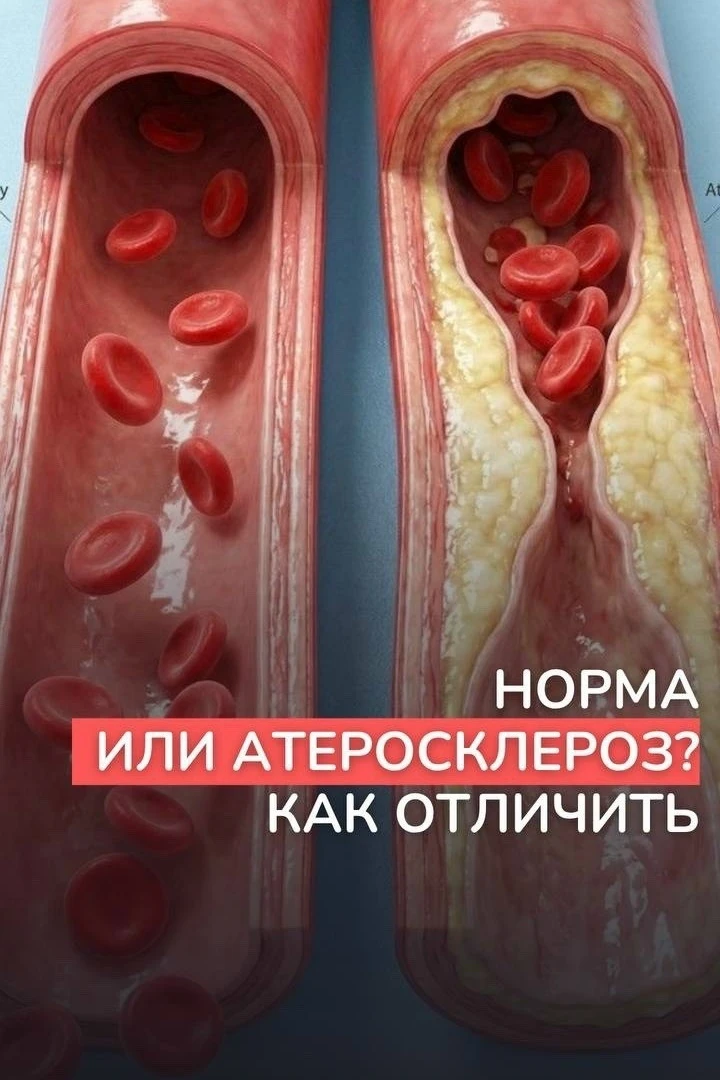 Как распознать атеросклероз и его симптомы