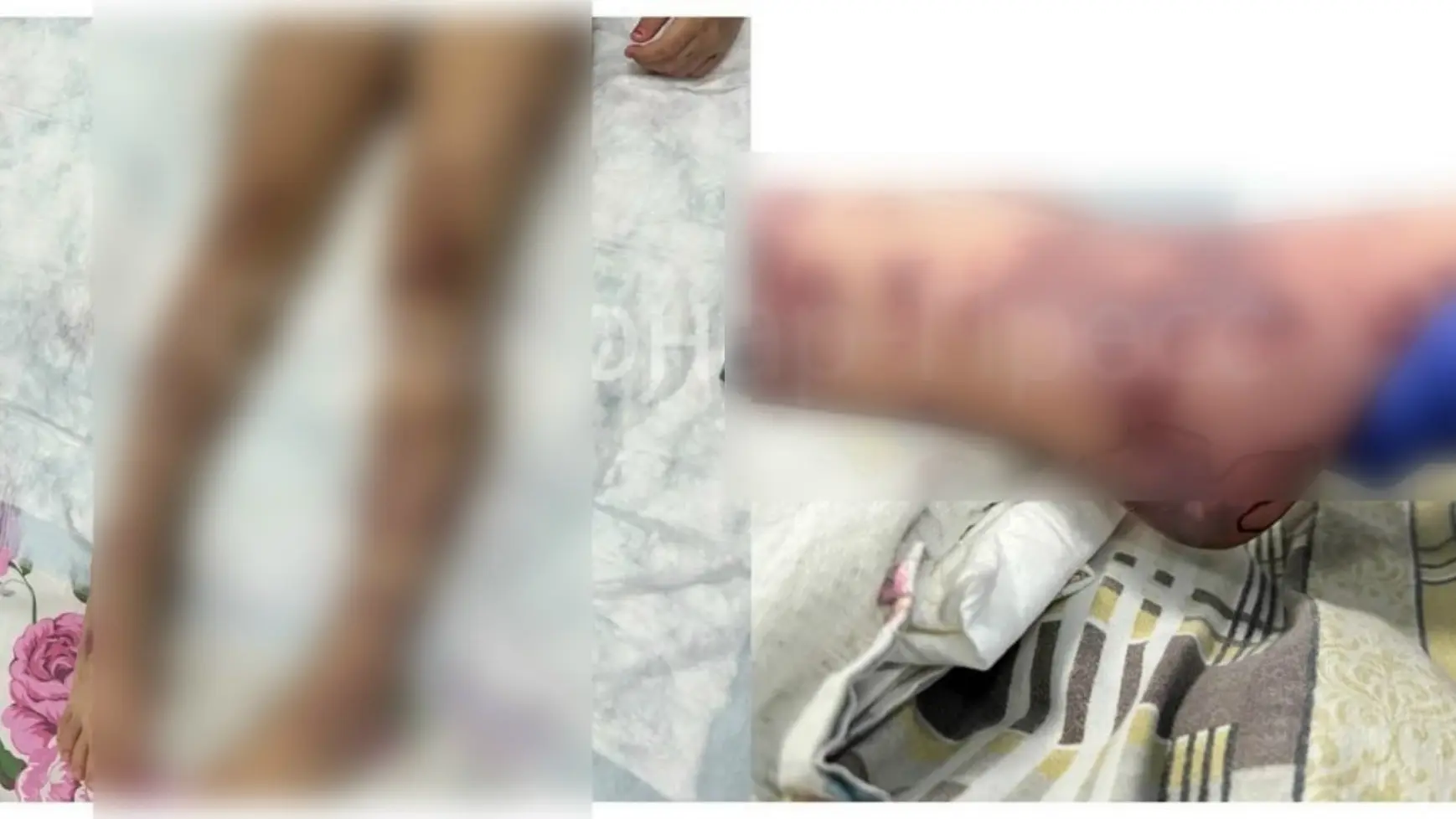 🏥 Нижегородские врачи спасли девочку с тяжелейшей менингококковой инфекцией.