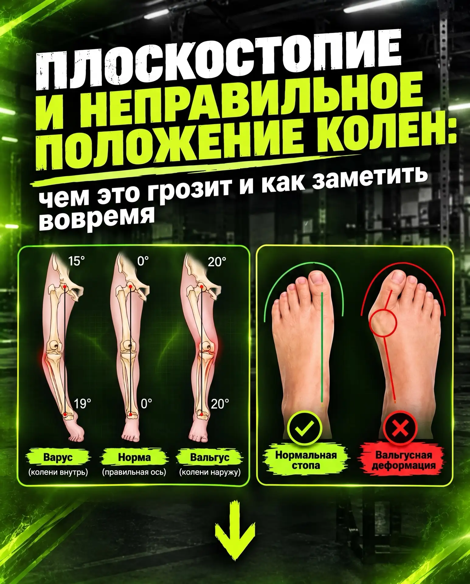 ✅ Плоскостопие и завал коленей: почему тренировки могут вредить и как это заметить?