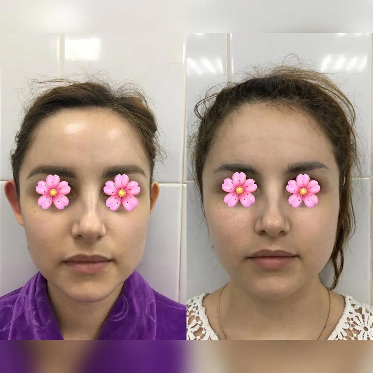 👂🏻Фото моей замечательной  пациентки после проведенной отопластики (коррекции отстоян...