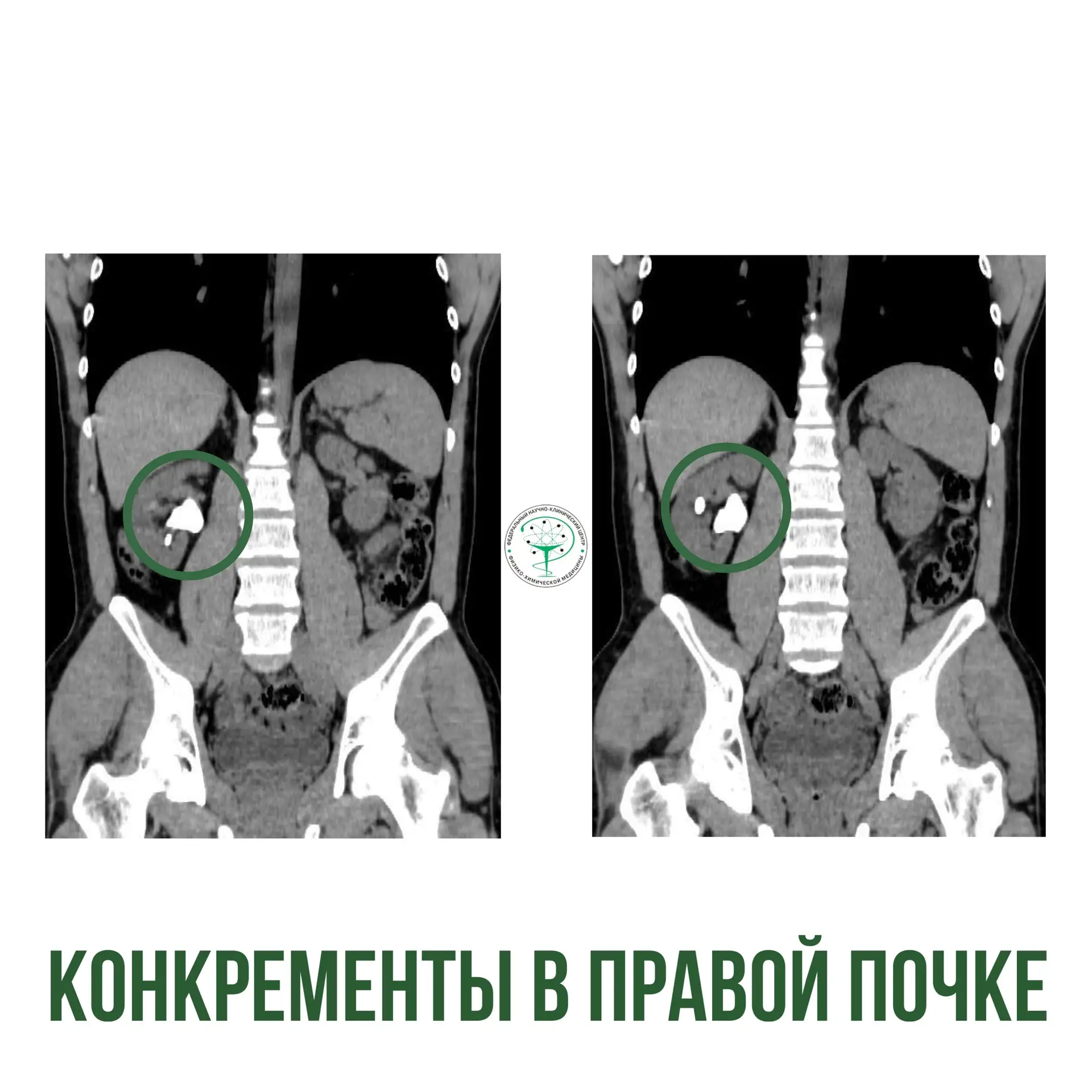 💉 Когда стандартные методы бессильны: как мы помогли пациенту с очень сложной мочекаме...