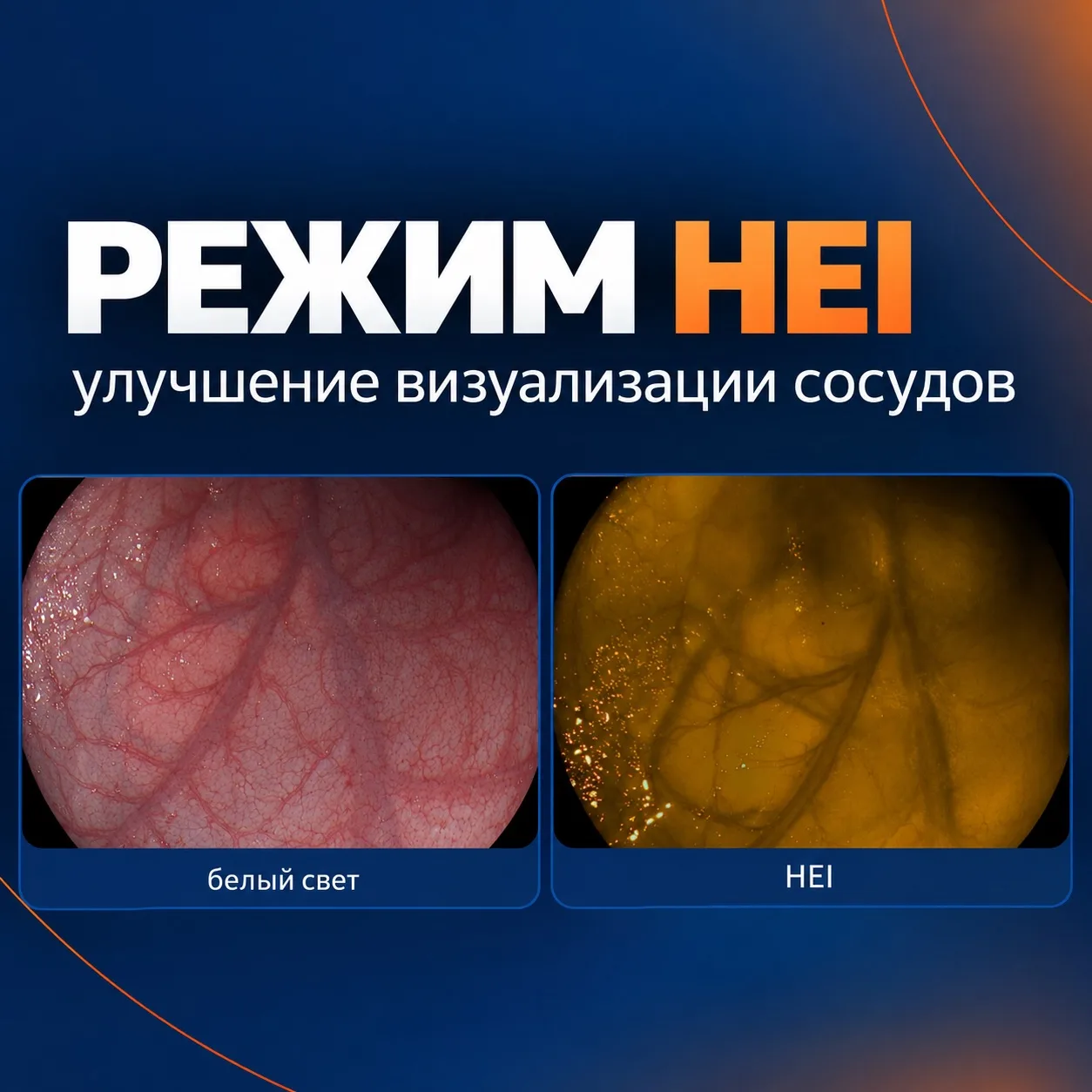Режим HEI: как сделать сосуд контрастнее
