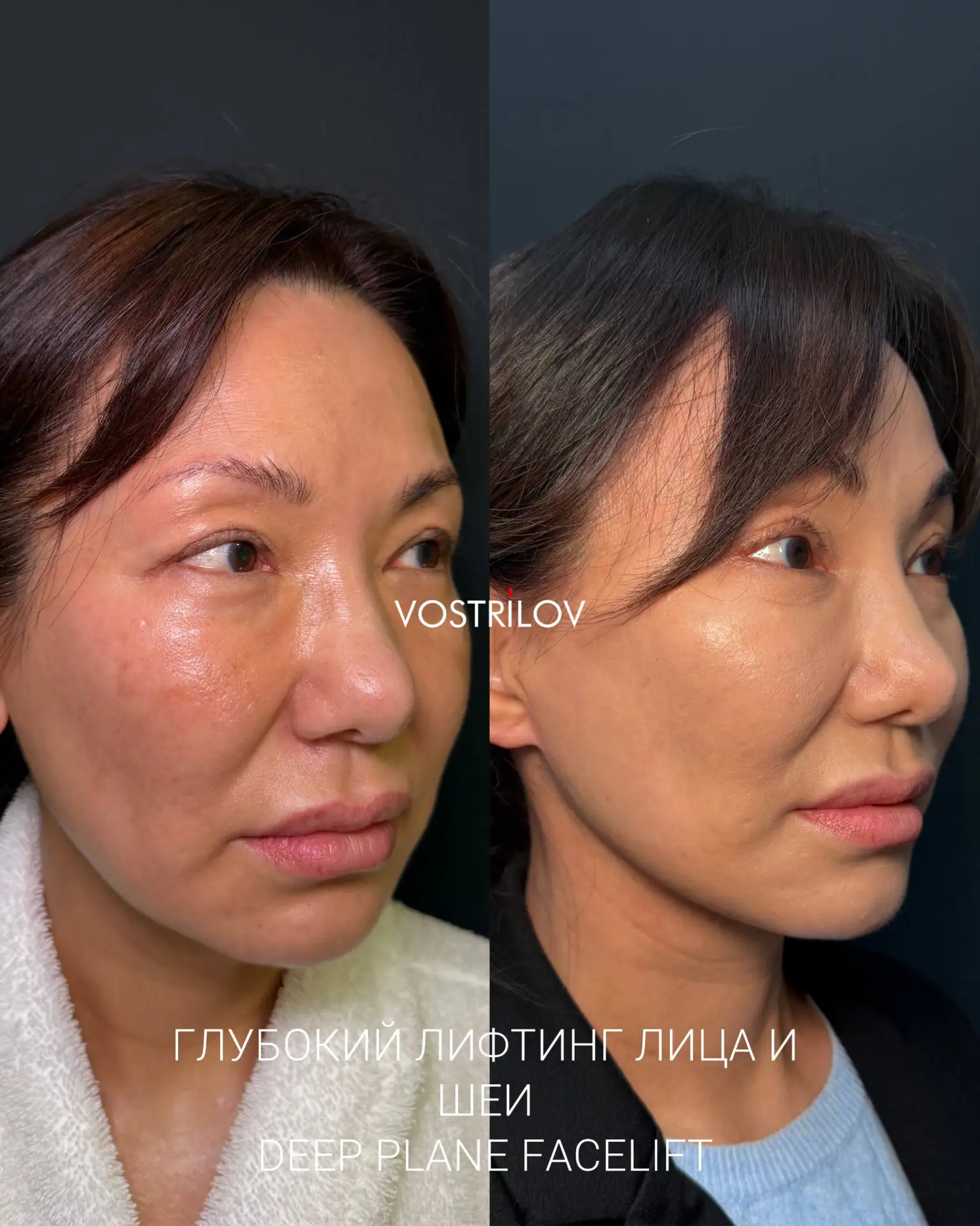 Новый результат комплексного омоложения лица и шеи у моей пациентки: