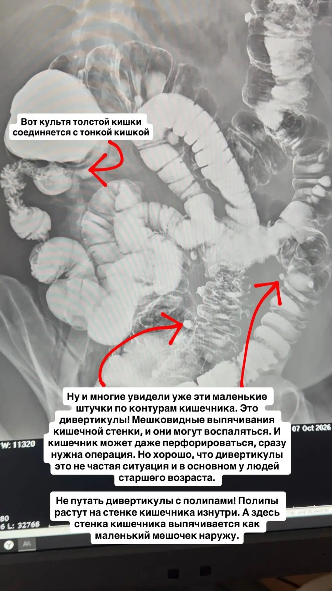 Ирригоскопия: что это за исследование и зачем оно нужно?