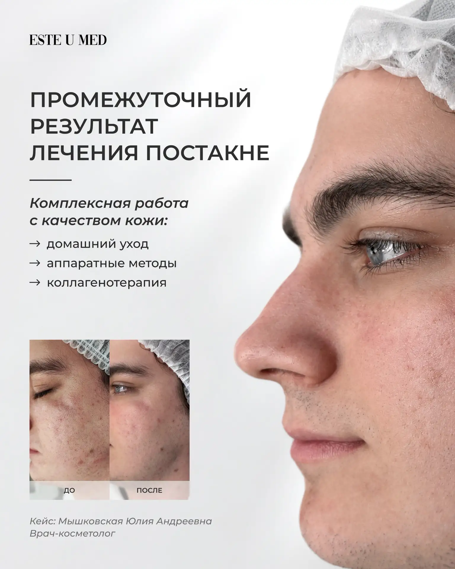 Акне уже позади, но кожа всё ещё хранит его следы