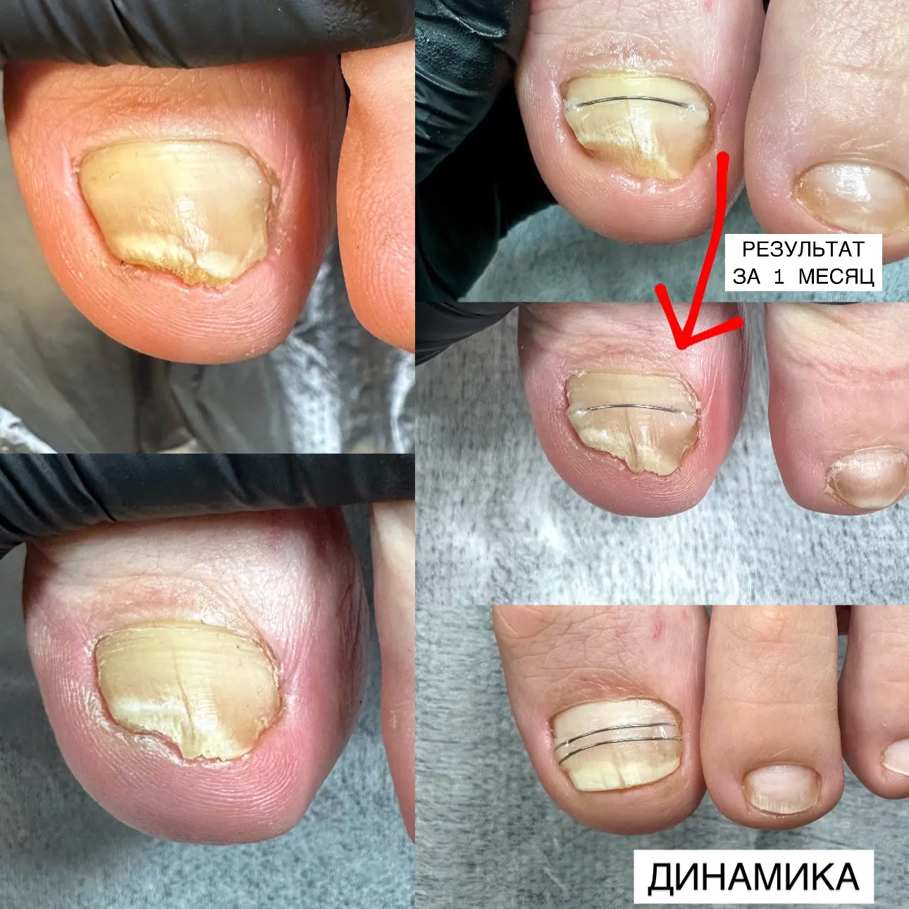 🦠 Микоз вылечили. А ногтю ещё нужно восстановиться
