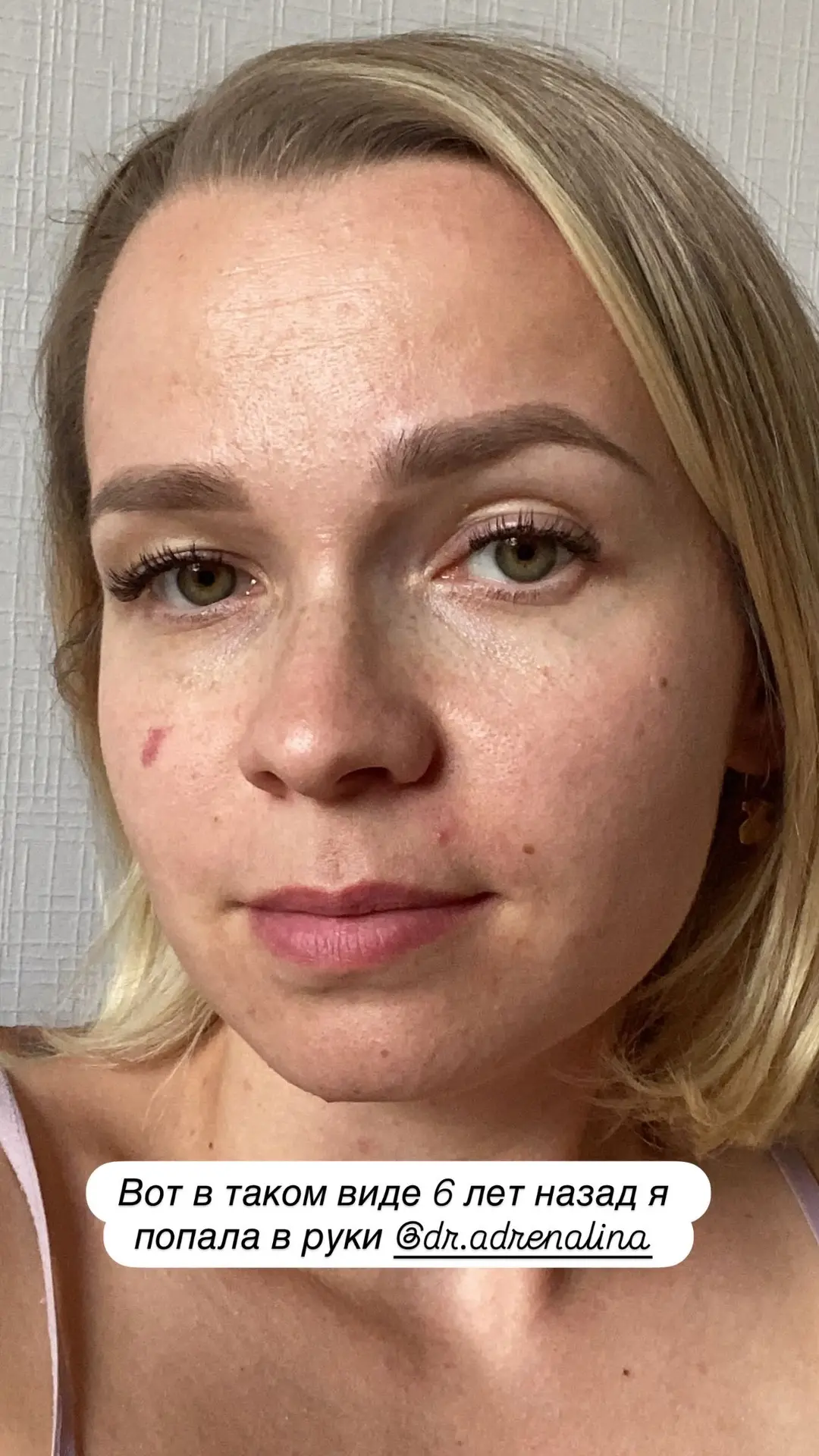 Кстати, это я до косметологии