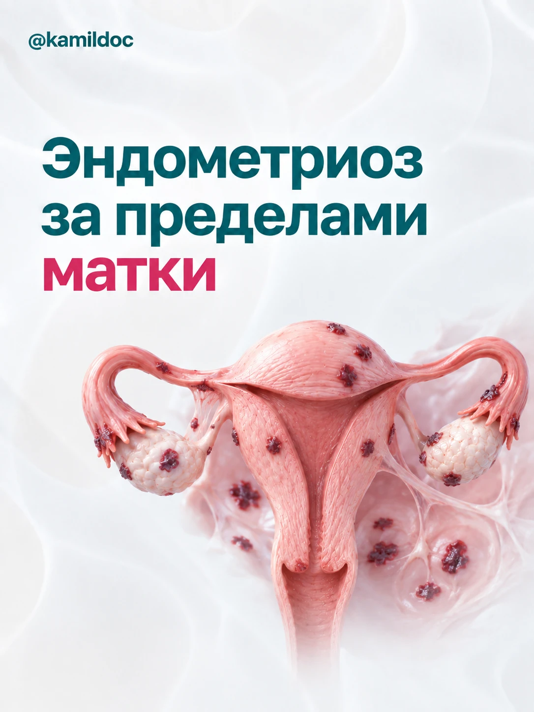 Эндометриоз в пупке, легких и не только: как его лечат за пределами матки