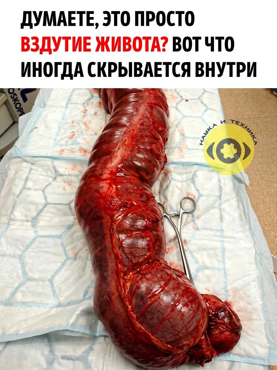 На фотографии показан необычайно увеличенный участок кишечника. Подобное патологическое...