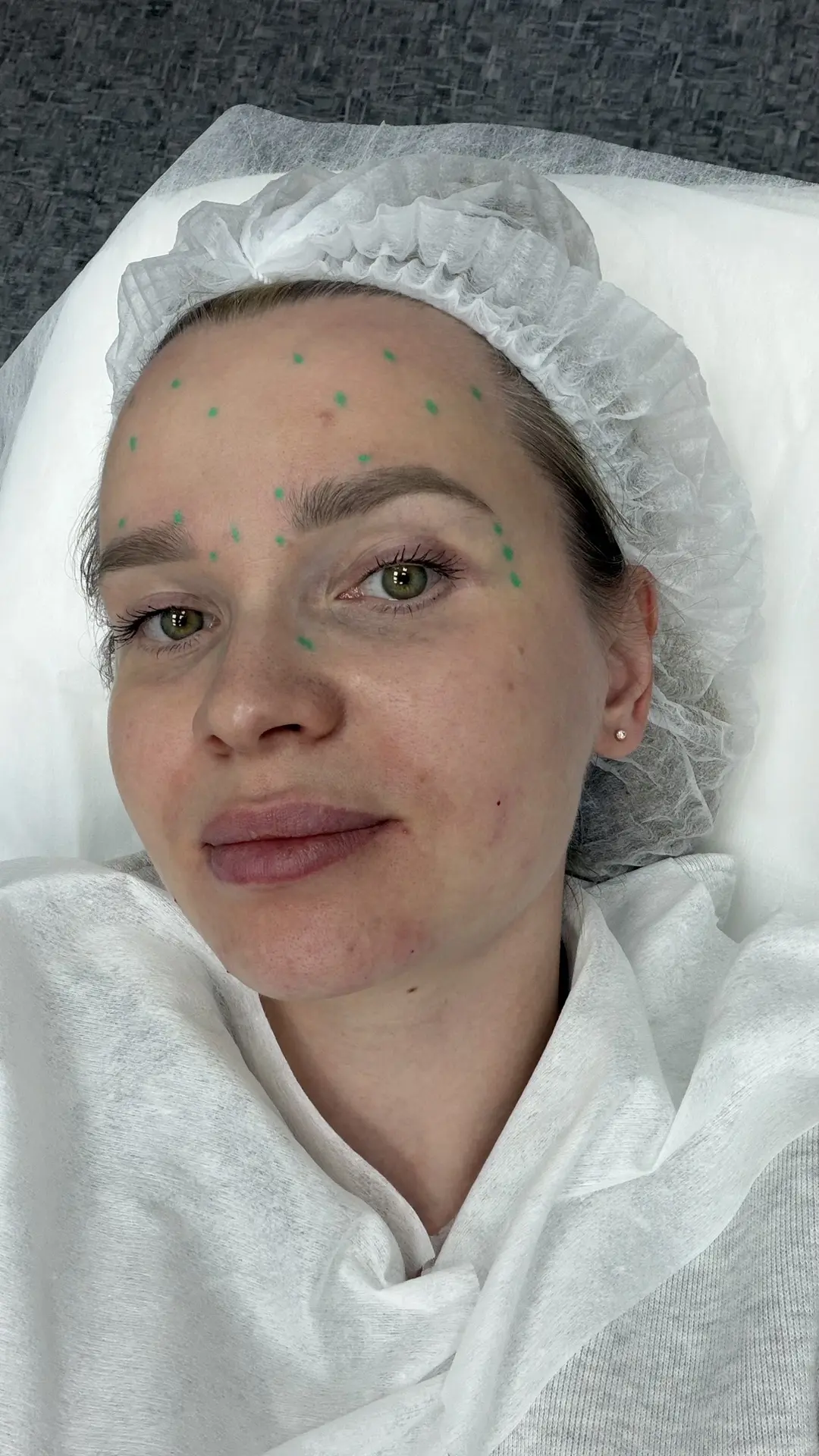Сегодня я по ботулококсину. Делаете себе?