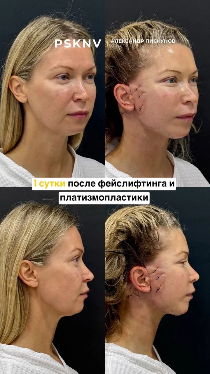 14-е сутки после фейслитфинга(DEEP SMAS) и медиальной платизмопластики