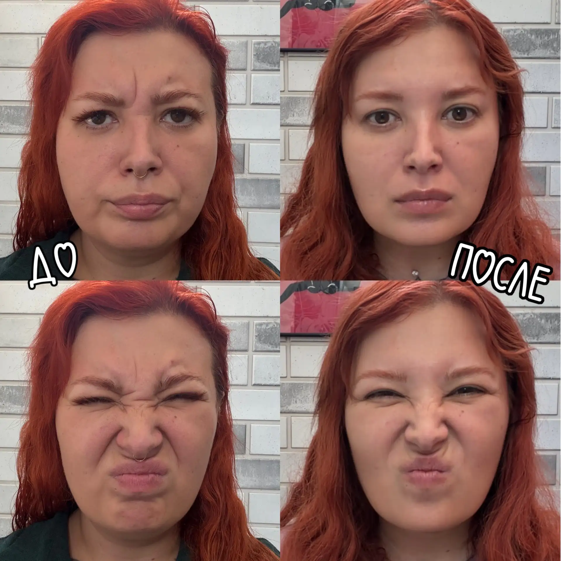 Наконец могу показать до/после первого в моей жизни ботокса 💉