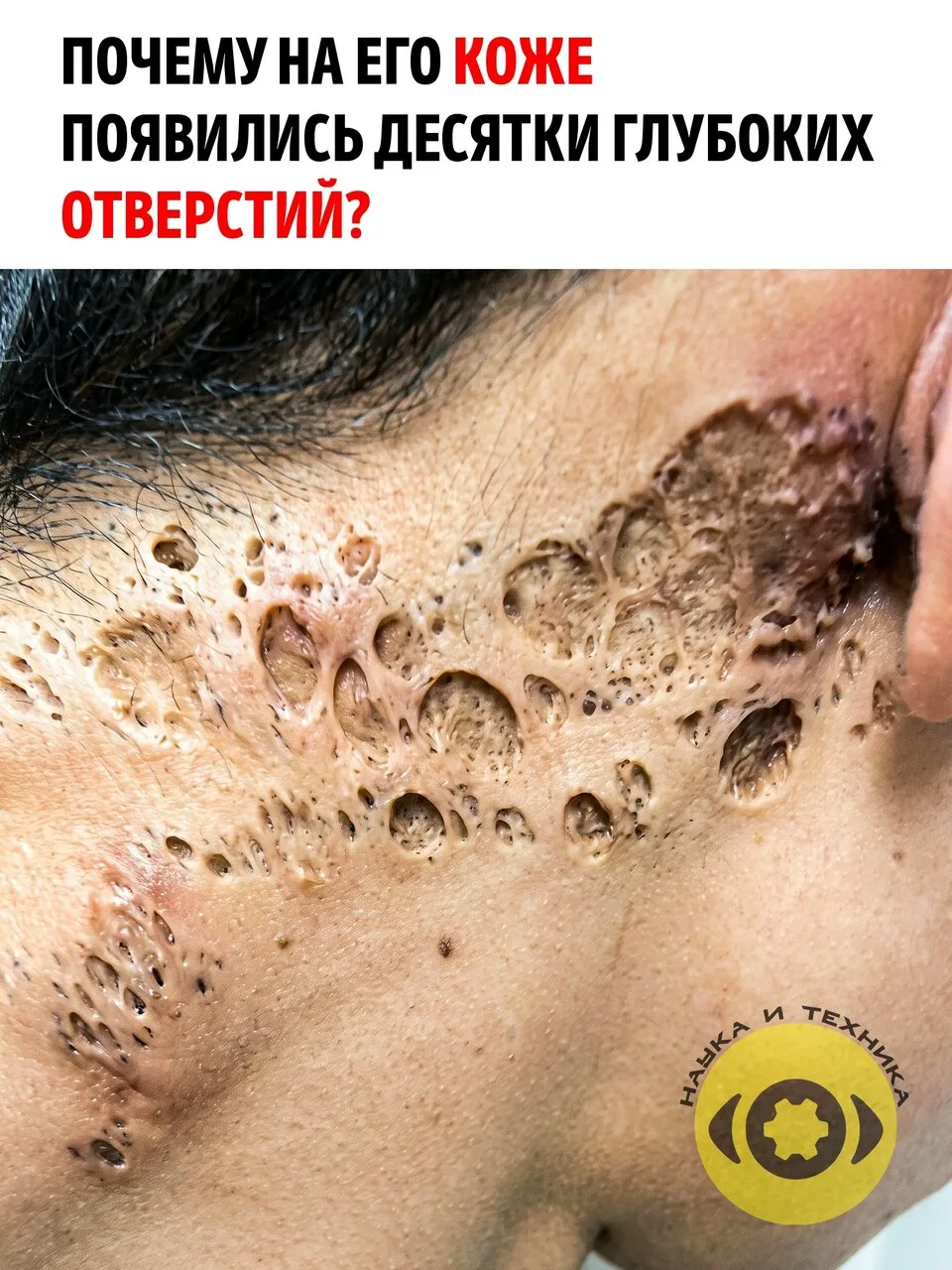 На первый взгляд кажется, будто кожа этого человека покрыта десятками глубоких дыр. Нек...