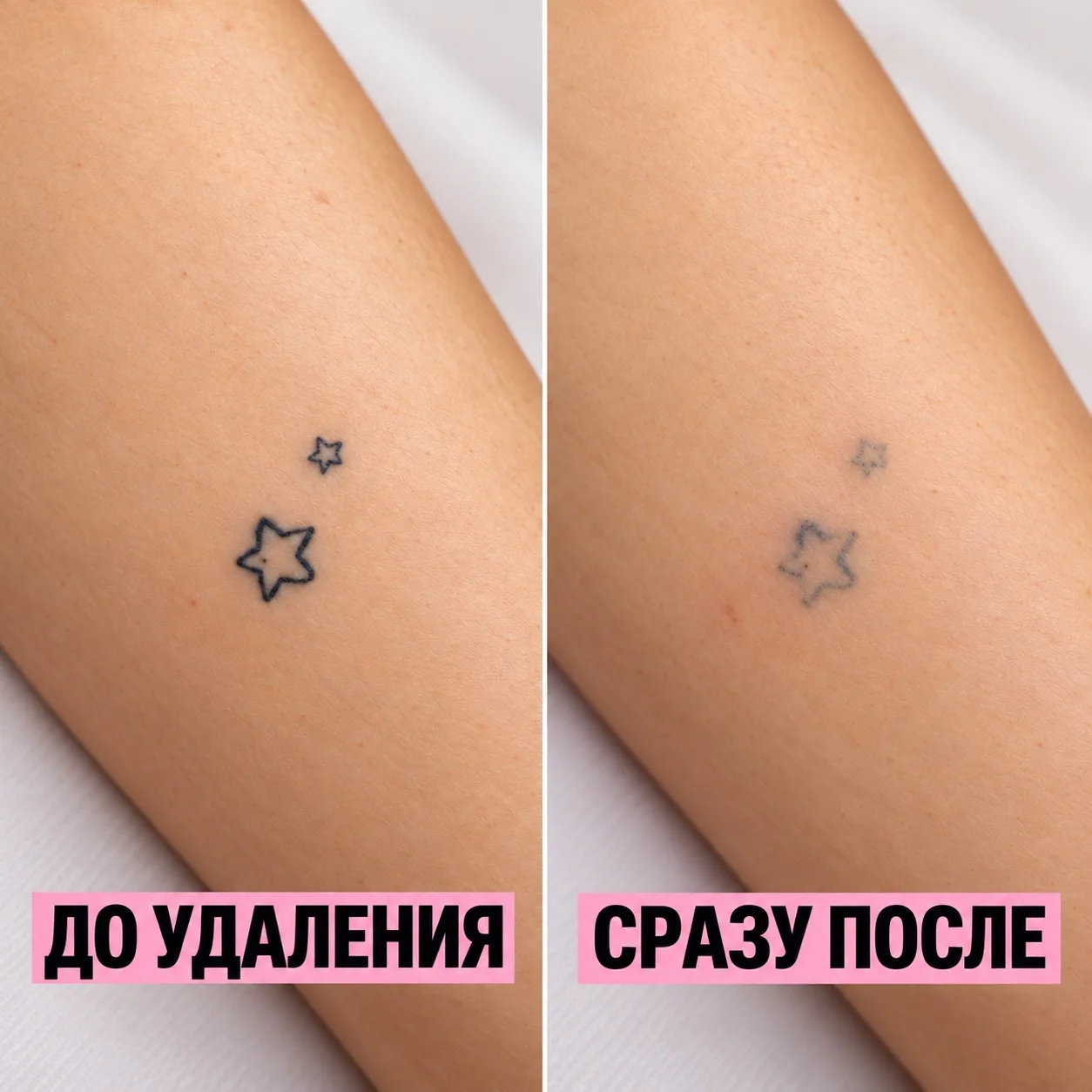 НЕУДАЧНАЯ ТАТУИРОВКА или СТАРЫЙ ПЕРМАНЕНТ❓