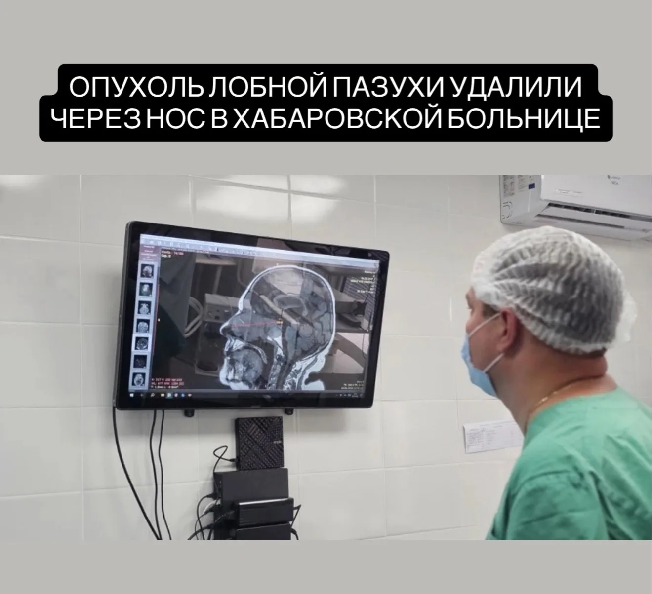 В Хабаровске врачи удалили опухоль из пазухи пациента без единого разреза