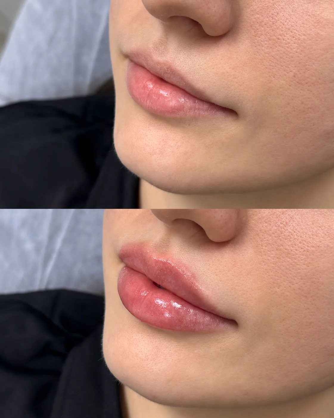 Контурная пластика губ препаратом Stylage M 💉