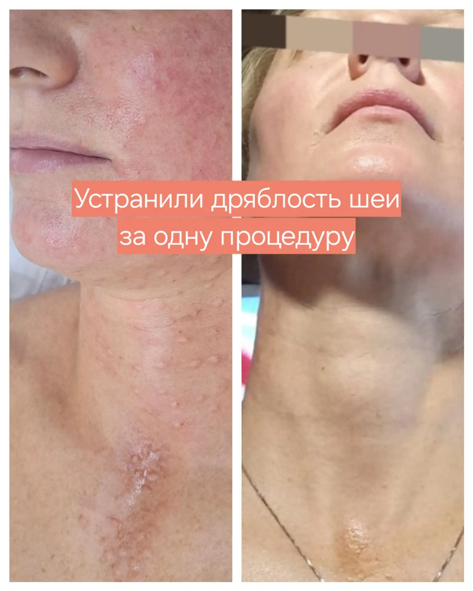 Устранили дряблость шеи за одну процедуру.