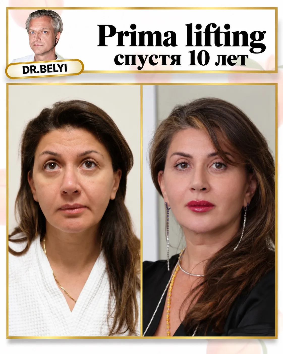 Вот так выглядит пациентка спустя 10 лет после подтяжки лица. Ничего никуда не опускает...