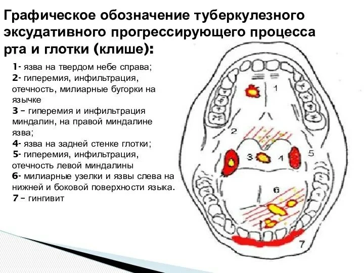 🦷 Продолжаем разговор о формах внелёгочного туберкулёза. Сегодня в фокусе — туберкулёз...