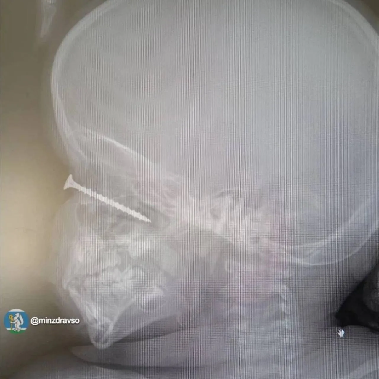🔴🔵Слабонервным не смотреть. Двухлетний ребёнок напоролся глазом на саморез в Свердлов...