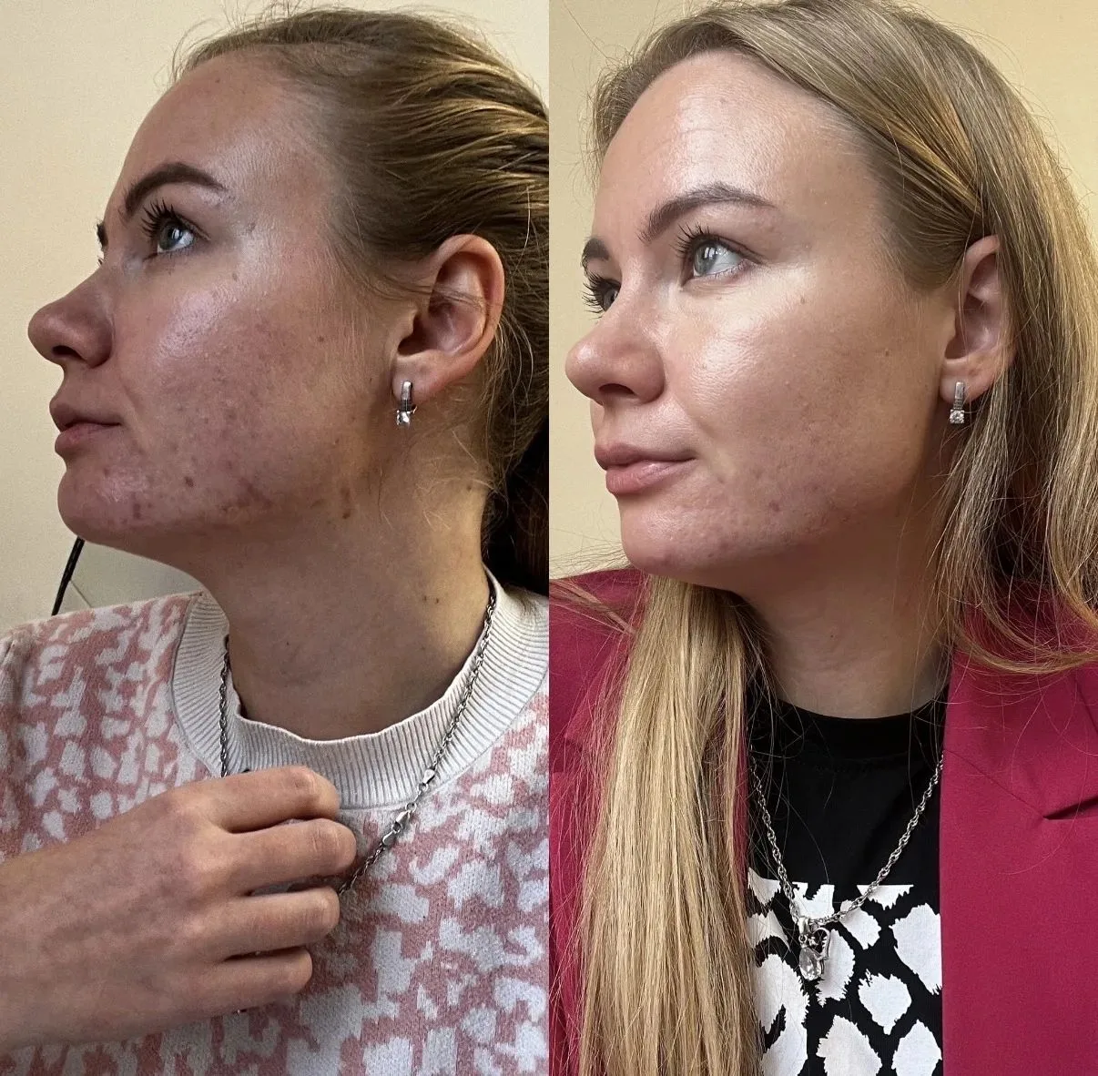 Хочу поделиться своим отзывом на продукты аюрведической линейки! Результат на фото с ра...