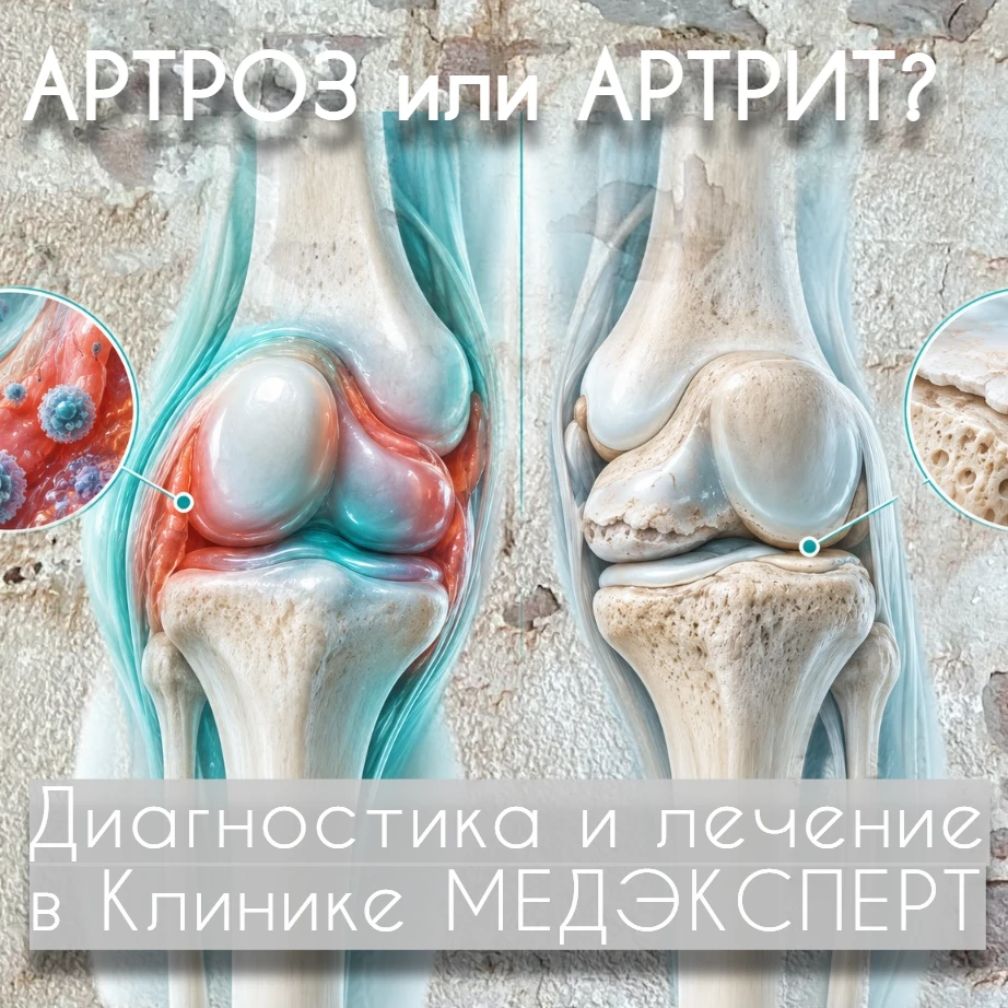 Заболевания суставов — артрит и артроз — способны серьёзно ухудшить качество жизни.