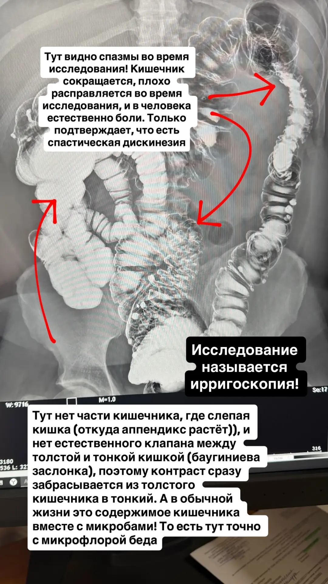 Ирригоскопия: что это за исследование и зачем оно нужно?