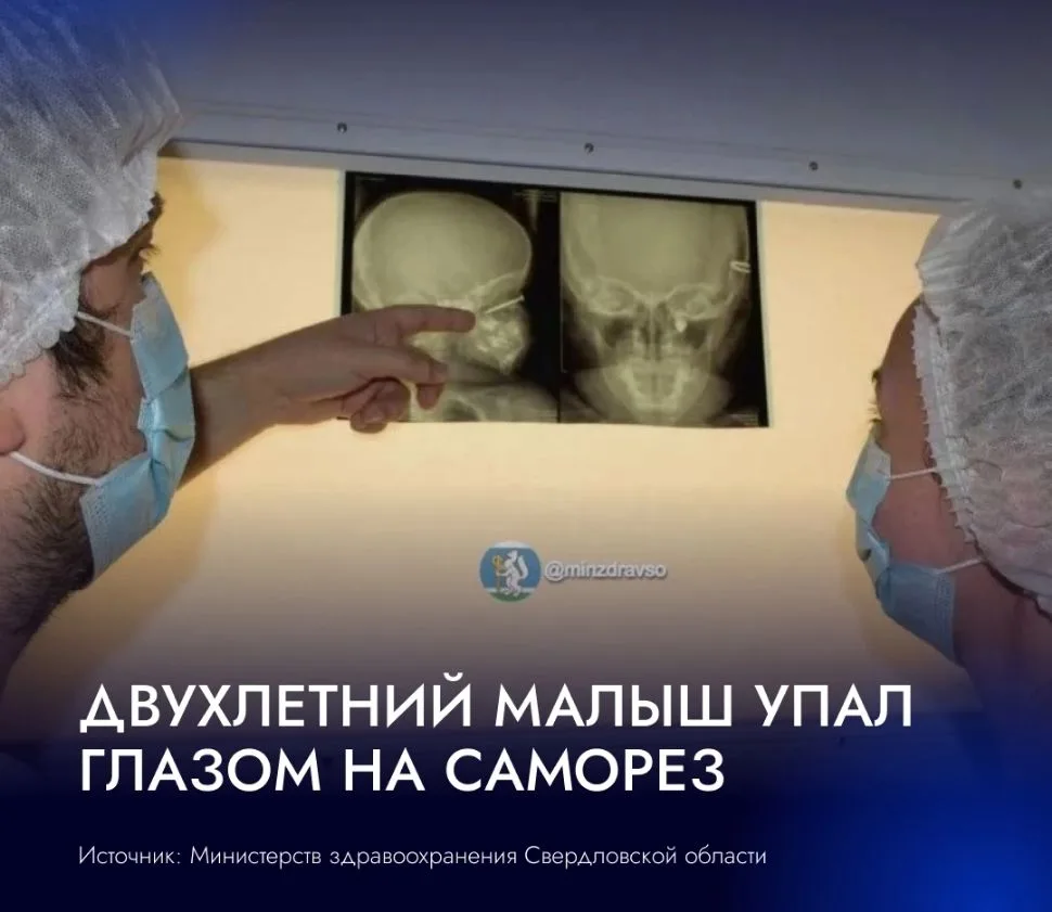 👶 Врачи спасли зрение двухлетнему мальчику, которому саморез попал прямо в глаз.