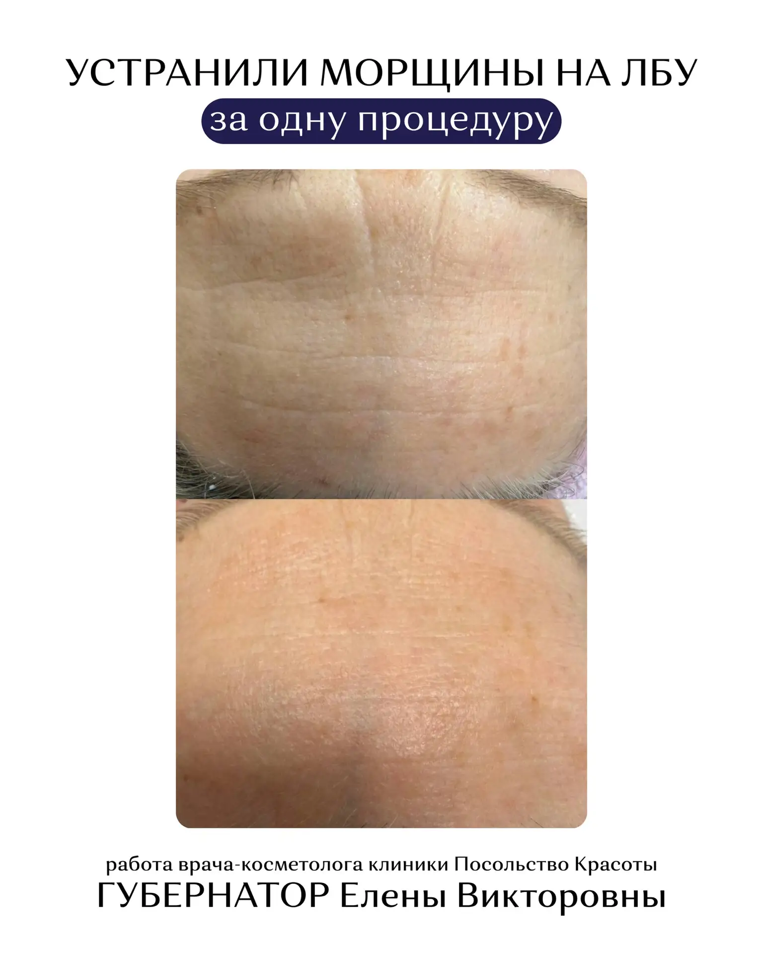 УСТРАНИЛИ МОРЩИНЫ НА ЛБУ ЗА 1 ПРОЦЕДУРУ 🔥