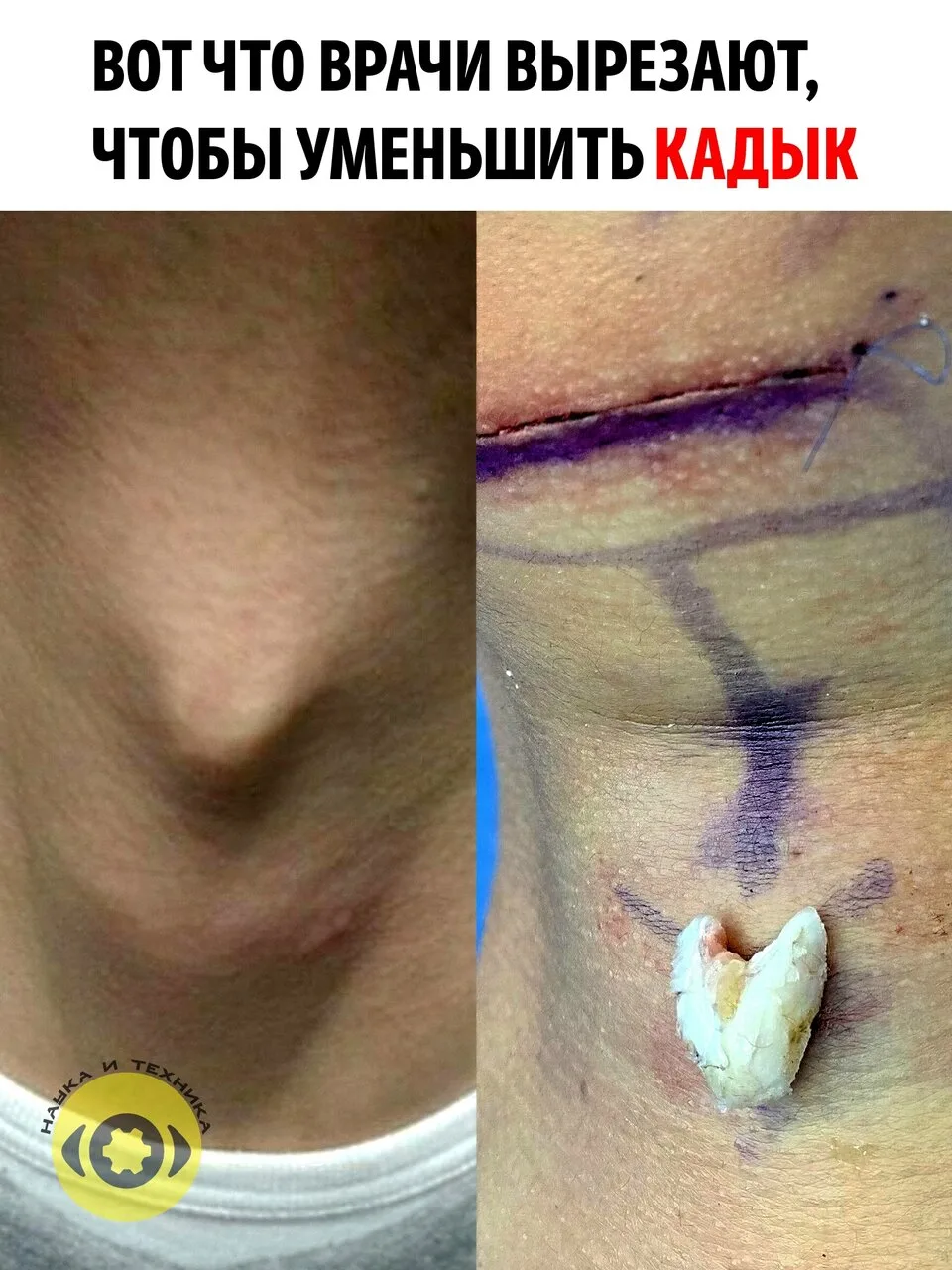 На фотографии справа показан фрагмент хряща, удалённый во время операции по уменьшению ...