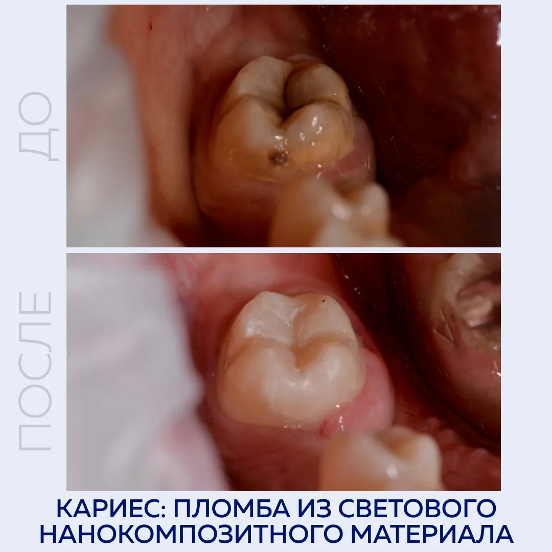 Лечение кариеса
