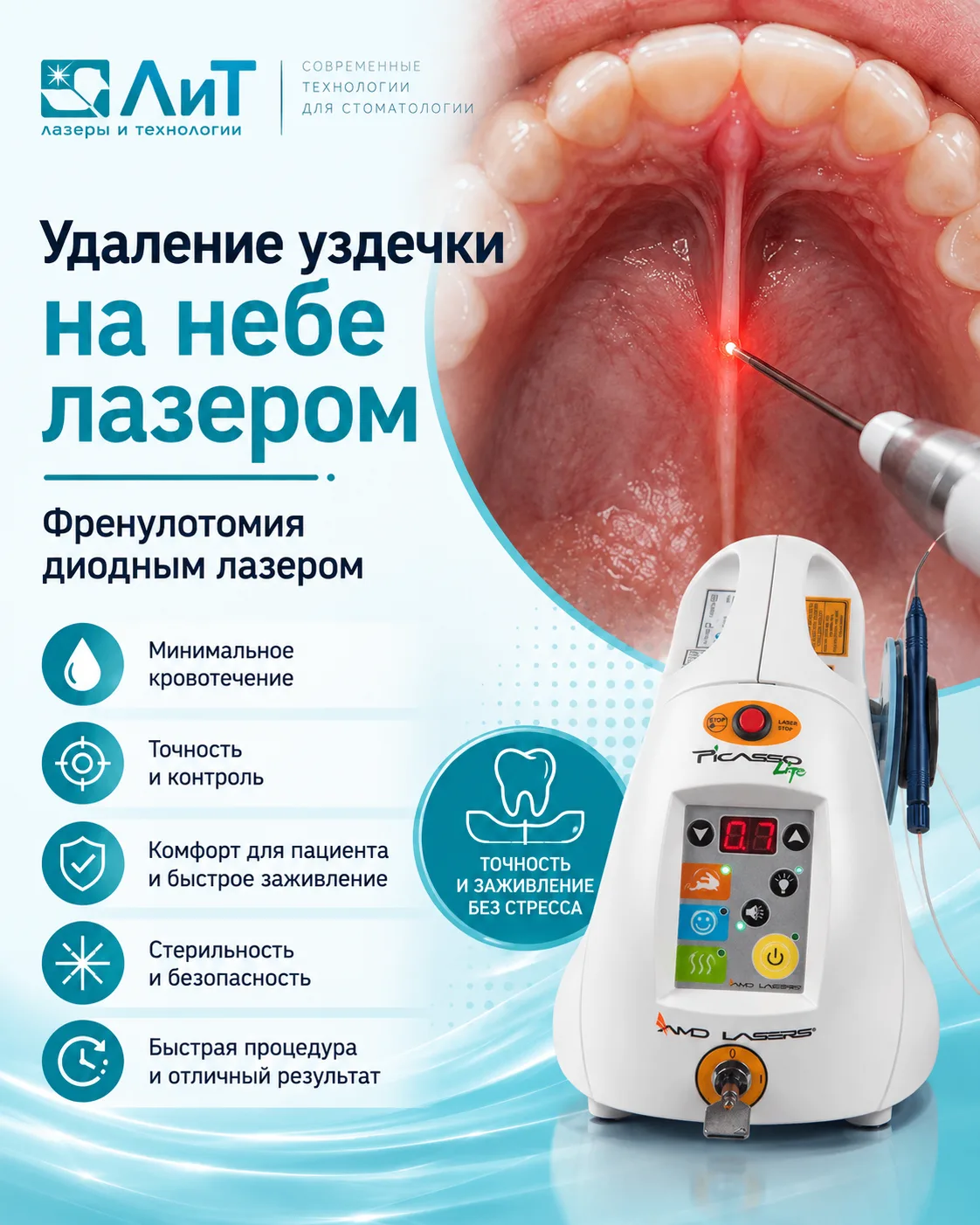 Френулотомия нёбной уздечки и диодный лазер