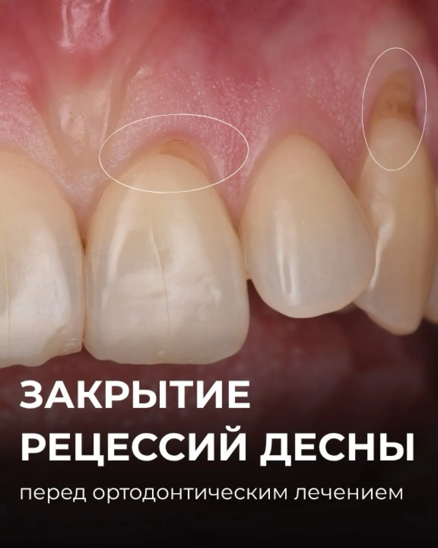Установка брекетов может усугубить рецессии и сделать их ещё больше.