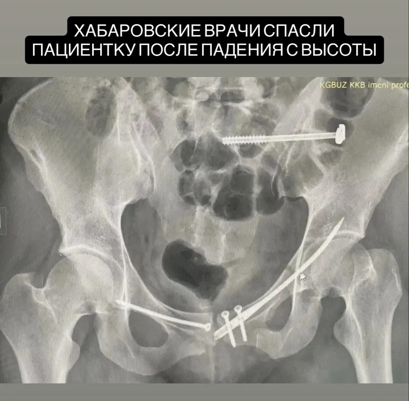 Хабаровские врачи спасли женщину после падения с высоты