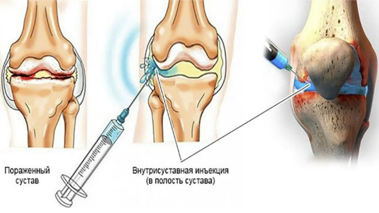 Здравствуйте,  может кто-то подскажет хорошего врача травматолога - ортопеда, который с...