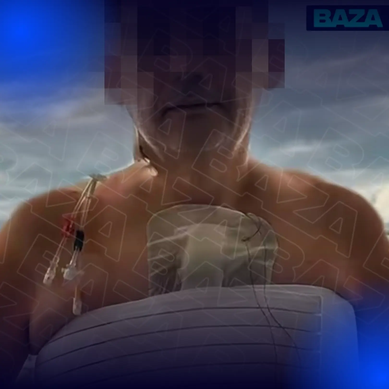 🦷Москвичу пришлось заменить клапан сердца после чистки зубов.
