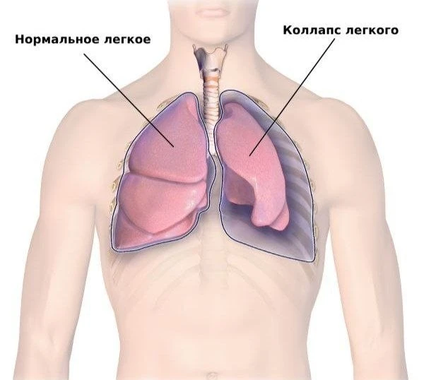 Российская молодежь массово страдает от схлопывания лёгких и гипоксии из-за вейпов — за...