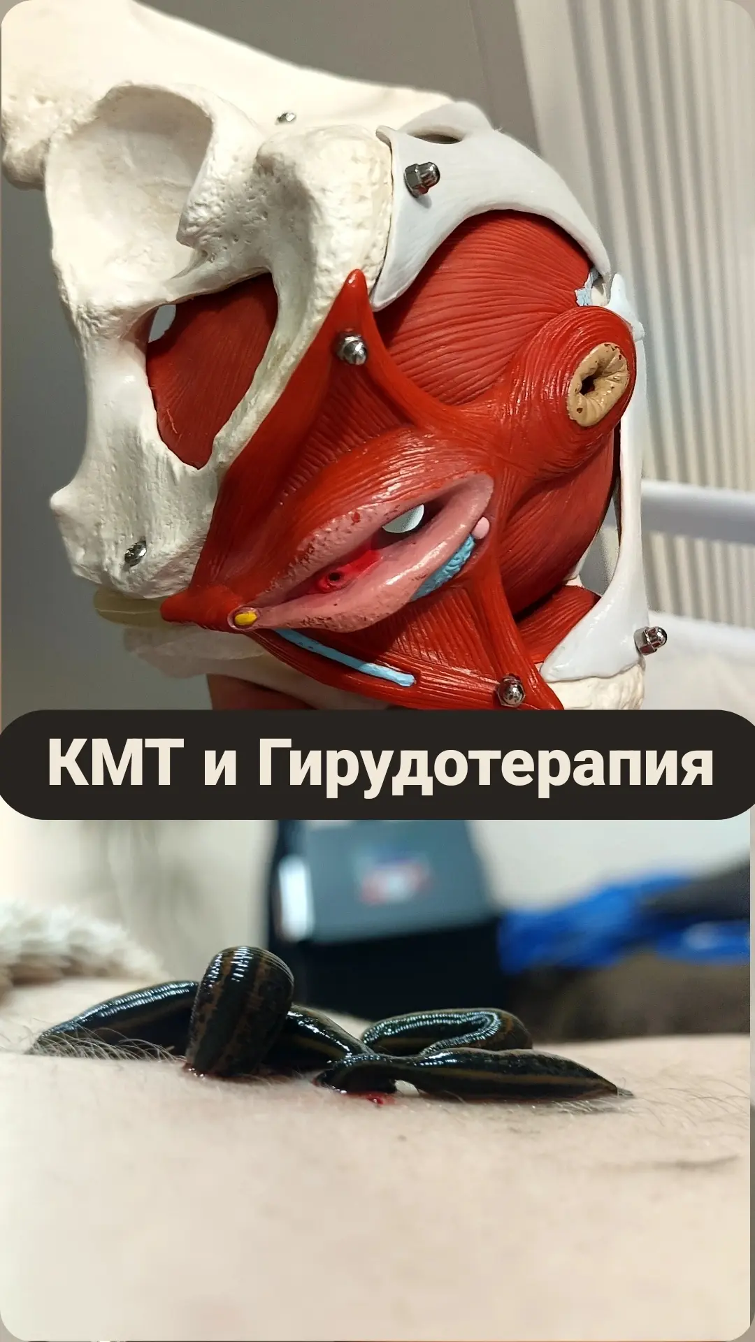 ✅Сочетание Коррекции малого таза и Гирудотерапии —  комплексный подход, который объедин...