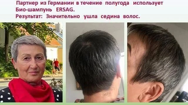 Капать 20 капель масла вишнёвых косточек в шампунь .Взбалтывать. Это очень хорошо помог...
