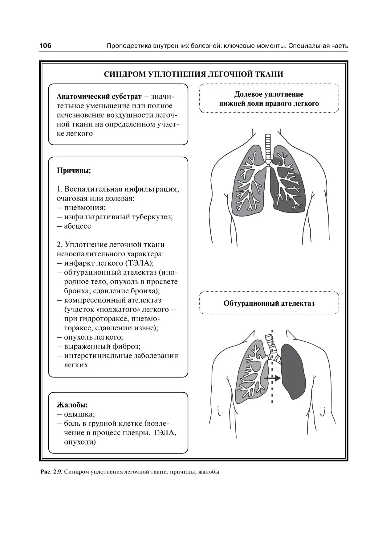 Синдром уплотнения легочной ткани