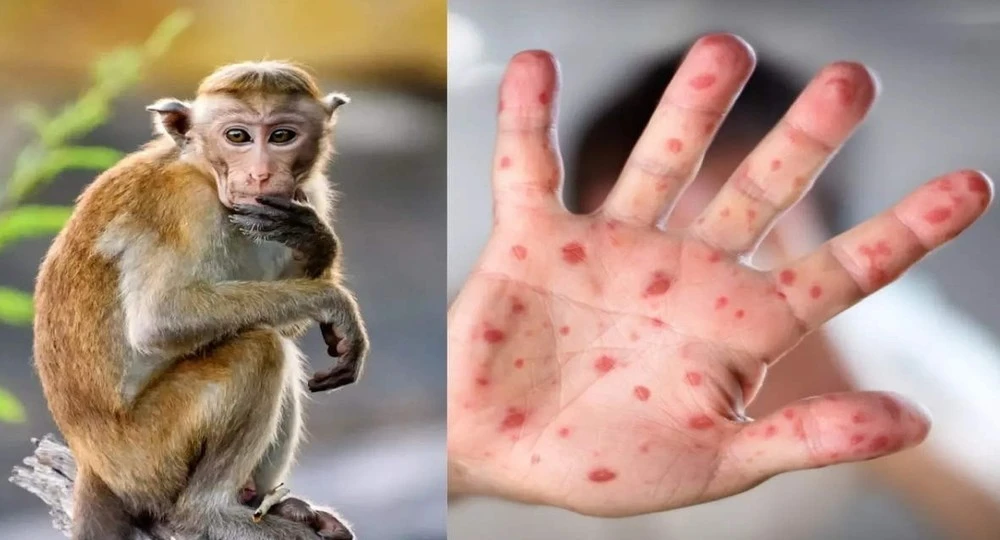 😷 Оспу обезьян заподозрили сразу у пяти жителей Подмосковья