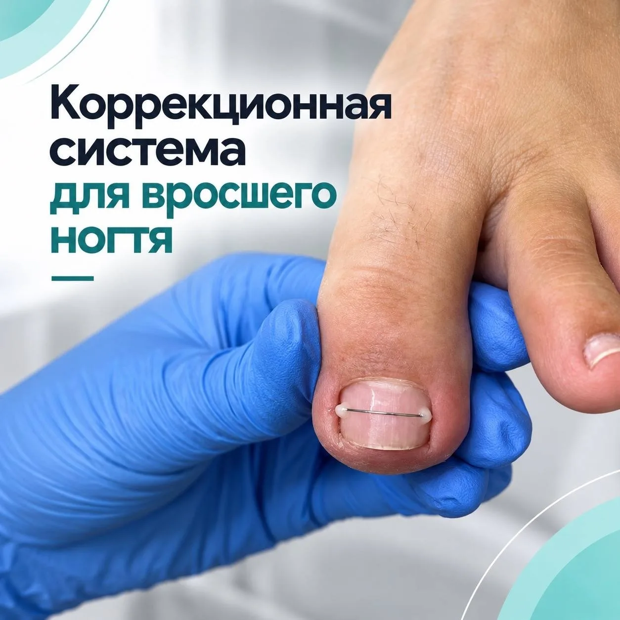 ✅Коррекционная система для вросшего ногтя